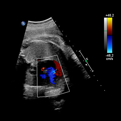 Fetal echocardiography in Vijayawada